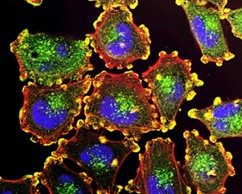 Alice Chang Ph.D on Uncovering A New Metabolic-Epigenetic Relationship for Breast Cancer Treatment Alice Chang Ph.D on Uncovering A New Metabolic-Epigenetic Relationship for Breast Cancer Treatment